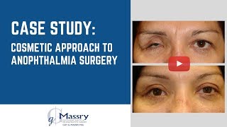 Cosmetic Approach to Anophthalmia Surgery  Dr Guy Massry Beverly Hills [upl. by Dielle]