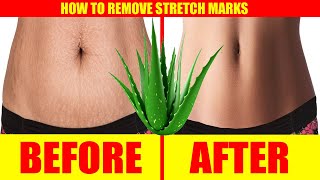 Stretch Marks Removal At Home – How to Remove Stretch Marks after Pregnancy  Natural Home Remedy [upl. by Rossie]