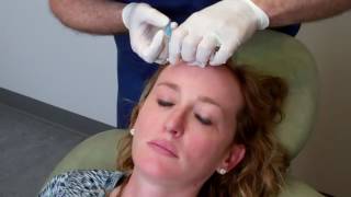 Brow Lift with PDO threads Lawrence Janowski MD [upl. by Eidissac]