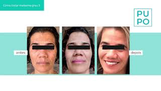 MELASMA GRAVE GRAU 3 ANTES E DEPOIS [upl. by Fiel]