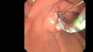 ERCP sphincterotomy stone extraction [upl. by Kalman]