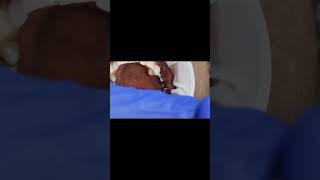 Molar implants 4 month post op osseointesratun  Tapping sound [upl. by Loftis]