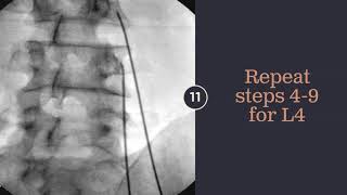 5 Minute Lumbar Medial Branch Radiofrequency Ablation [upl. by Nwahsat]