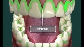 Tooth Decay  How it Happens and How to Avoid it [upl. by Gomez]