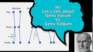 Hippo Genu Valgum vs Genu Varum [upl. by Wattenberg]