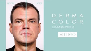 How To Cover Vitiligo With Dermacolor  Kryolan Makeup Tutorial For Flawless Coverage [upl. by Lefkowitz]