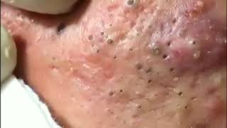 Best Blackhead Removal Ever 2020 [upl. by Cece]