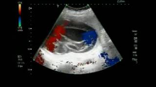 Ultrasound Video showing Hydatid Cyst in the Spleen [upl. by Besnard]