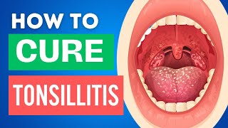 10 Home Remedies for Tonsillitis  Tonsillitis Treatments at Home [upl. by Akelam]