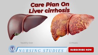 Care Plan On LIVER CIRRHOSIS   nursing [upl. by Jedediah156]