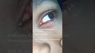 Chalazion eye cyst and electro homoeopathy [upl. by Anielram827]