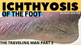 Ichthyosis of the Foot Travelin Mans Severe Skin Condition and Treatment [upl. by Beck608]