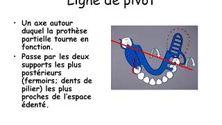 Rétention indirecte pour la prothèse partielle amovible [upl. by Woodring]