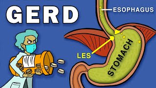 Gastroesophageal Reflux Disease GERD [upl. by Enytsirk754]