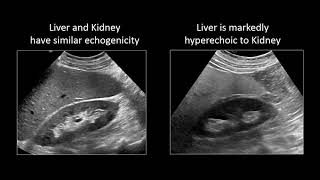 GI Imaging  Hepatic Steatosis and Cirrhosis [upl. by Leynad262]