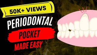 Periodontal disease  Periodontal pocket [upl. by Yztim777]