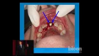 Learning from My Mistakes How to Drill Perfect Bicon Osteotomies Every Time [upl. by Kauffmann]