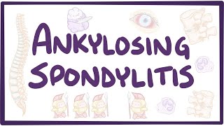 Ankylosing spondylitis  causes symptoms diagnosis treatment pathology [upl. by Sredna167]