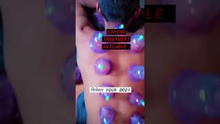 cupping therapy treatment [upl. by Aiciled]