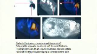 PET Scan in Orthopaedics [upl. by Leonhard]