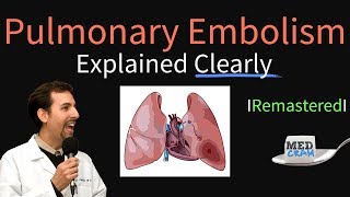 Pulmonary Embolism Remastered  Pathophysiology Symptoms Diagnosis DVT [upl. by Dewitt]