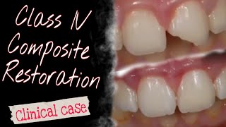 Class IV Composite Restoration Clinical case [upl. by China]