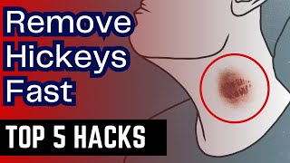 How to Remove HICKEYS Fast  5 Proven Methods That Work  Get Rid of Hickey Quickly [upl. by Meade]