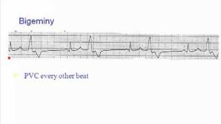 ECG PVCs in Various Patterns [upl. by Ardnikal]