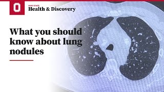 What you should know about lung nodules  Ohio State Medical Center [upl. by Yeleek]