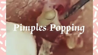 Pimples amp Blackheads Popping  56 [upl. by Vivyanne48]