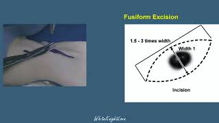 8 1 Fusiform Excision Skin Flaps Essential Surgical Skills WhiteKnightLove [upl. by Boycey]