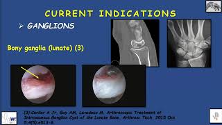 ARTHROSCOPIE DU POIGNET indications courantes et complications [upl. by Holna]