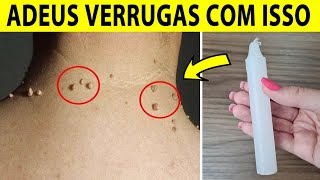 Como Eliminar VERRUGAS Para Sempre Usando uma Vela Verrugas Nunca Mais [upl. by Killion]