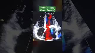 Mitral stenosis colour Doppler 2D echo cardiology echocardiography [upl. by Enilreug30]