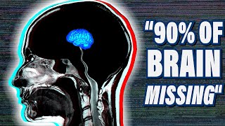 The Most Bizarre Medical Case in Neuroscience [upl. by Cressi221]