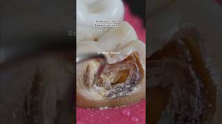 Deep caries Removal dental caries viral dentist fyp youtubeshorts smile cariesshorts tooth [upl. by Aneehsirk]