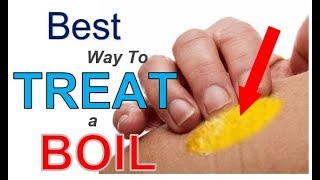 The BEST Way to TREAT a Boil 3 Simple Steps  Best REMEDY for Treating Boils FAST [upl. by Enalb114]