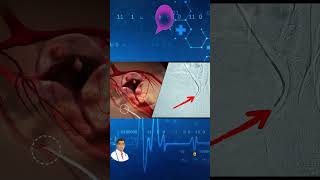 Uterine Fibroid Embolization Live Surgery [upl. by Ardnael714]