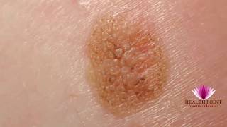 Melanoma Pictures  Signs Symptoms Causes Photos Images Pictures of Melanoma Skin Cancer [upl. by Hobart]