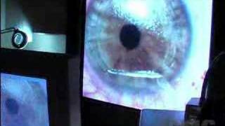 Lasik Eye Surgery [upl. by Odnanreh]