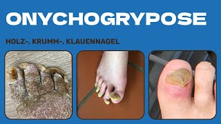 Onychogrypose Eine tief gehende Analyse der Nageldeformität podologinandrea [upl. by Hyacinthie120]