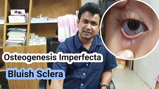 Osteogenesis Imperfecta  Bluish Sclera  Dr Abdullah Al Rafi [upl. by Lekram79]