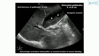 acalculous cholecystitis [upl. by Animsay]