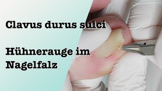 Clavus durus sulci Hühnerauge im Nagelfalz entfernen podologinandrea [upl. by Tompkins]