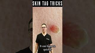 Skin Tag Removal amp Plantar Wart Removal Garlic Iodine amp Cider [upl. by Nrubloc307]