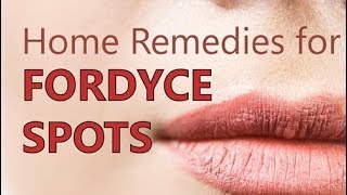 Home Remedies for Fordyce Spots  Treatment Methods Natural Cure [upl. by Matias298]