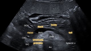 Ultrasound Abdomen Part 1 Pancreas How I do it Case study uncinate process neoplasm [upl. by Chema]