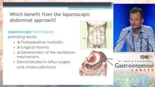 Minimally invasive surgery for cancer of the esophagus [upl. by Anitsyrc]