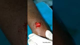 Papilloma surgery with agnikarma papillomaagnikarmaayurvedaforall [upl. by Anavoig92]