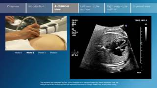 Key screening views of the fetal heart  Part 3  4chamber view [upl. by Aile]